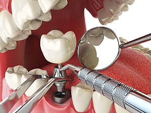 Dental Implant Surgery 3D Render with Surgical Instruments and Mirror HD wallpaper