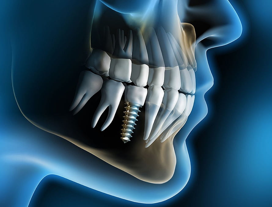 3D Medical Illustration of Dental Implant in Human Jaw and Teeth HD wallpaper