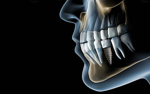 3D Medical Illustration of a Dental Implant in the Human Jaw and Skull HD wallpaper